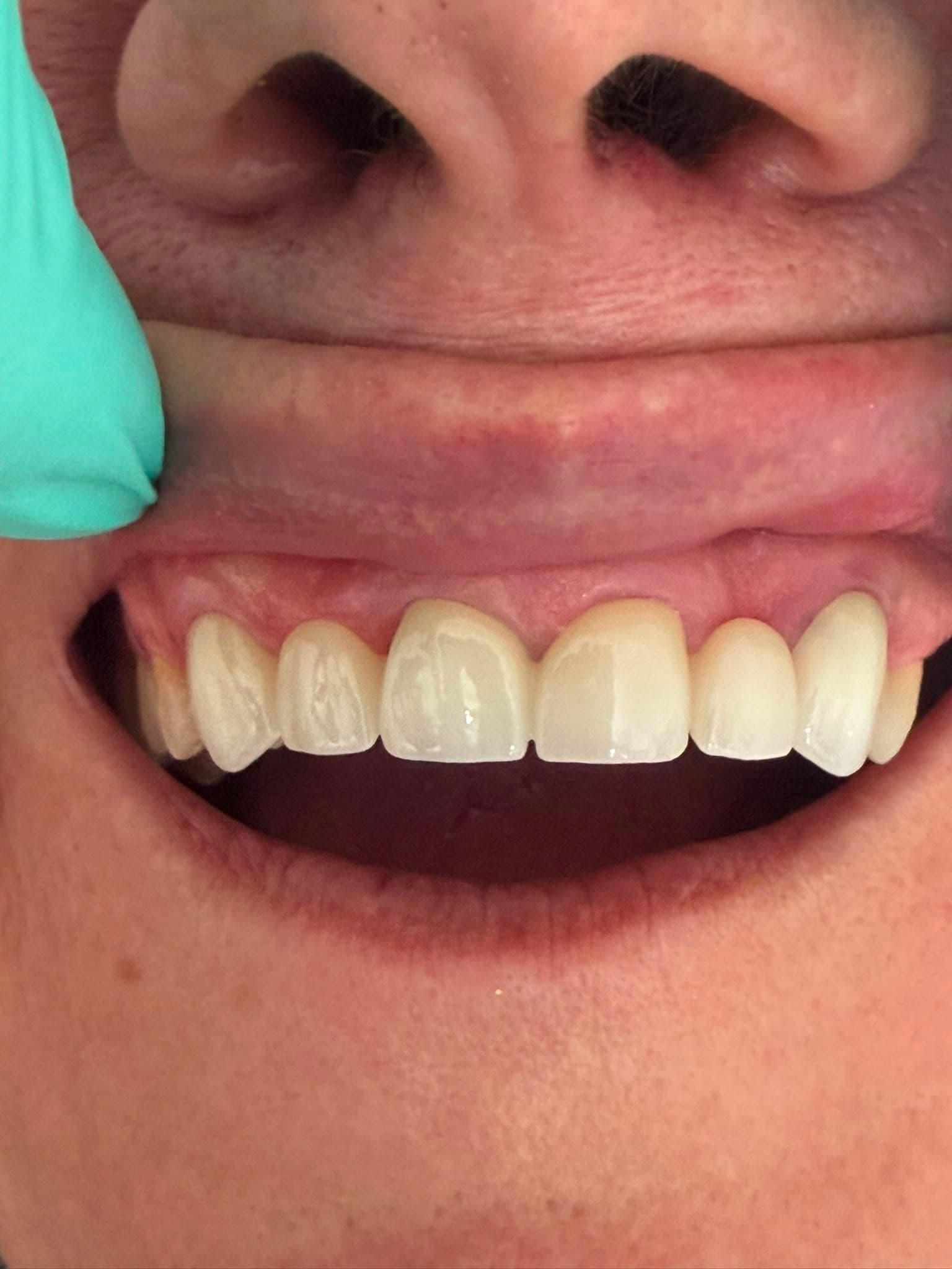 Dinți din zirconiu și punte dentară - Rezultat 1