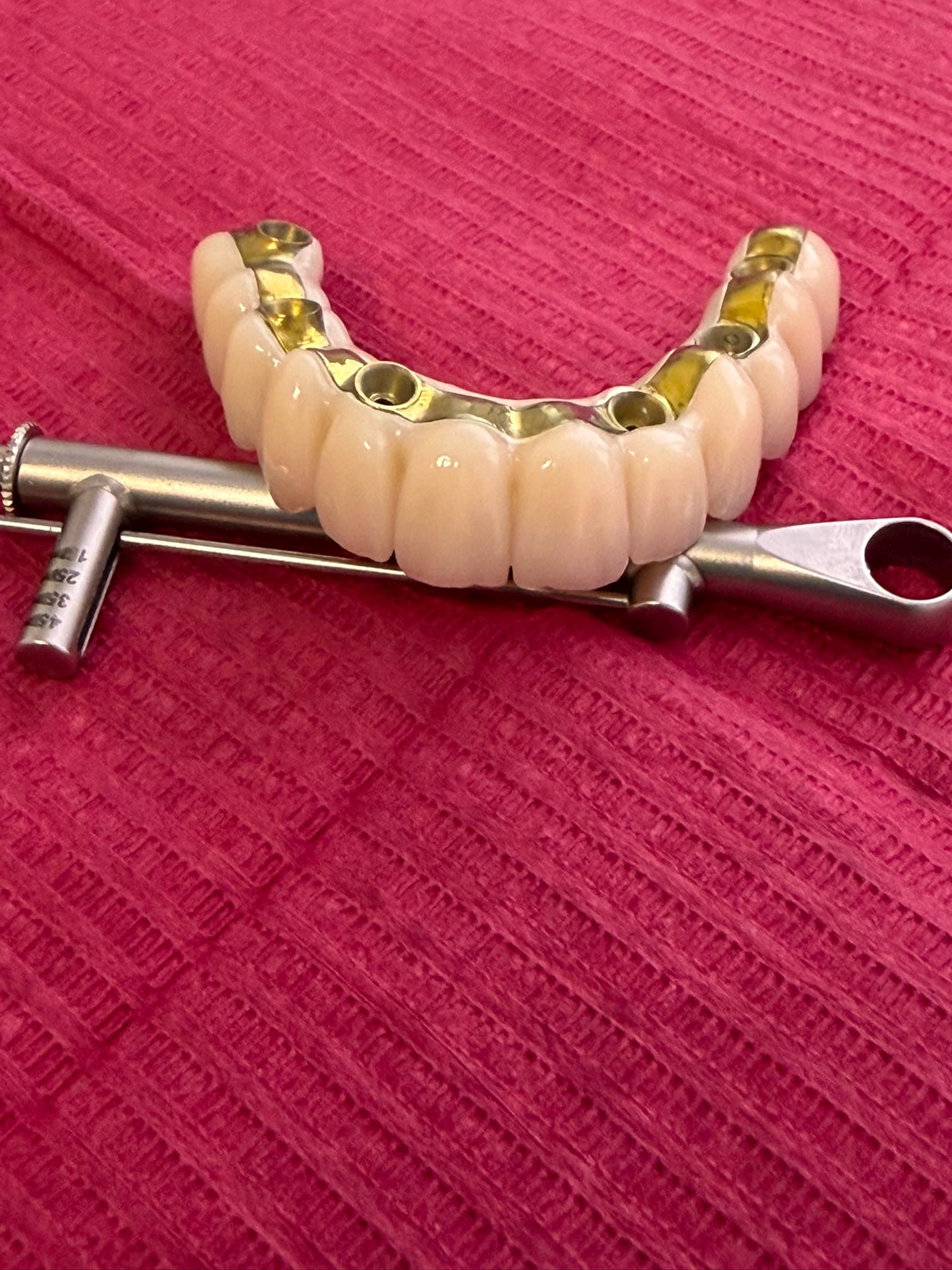 Dinți din zirconiu și punte dentară - Rezultat 2