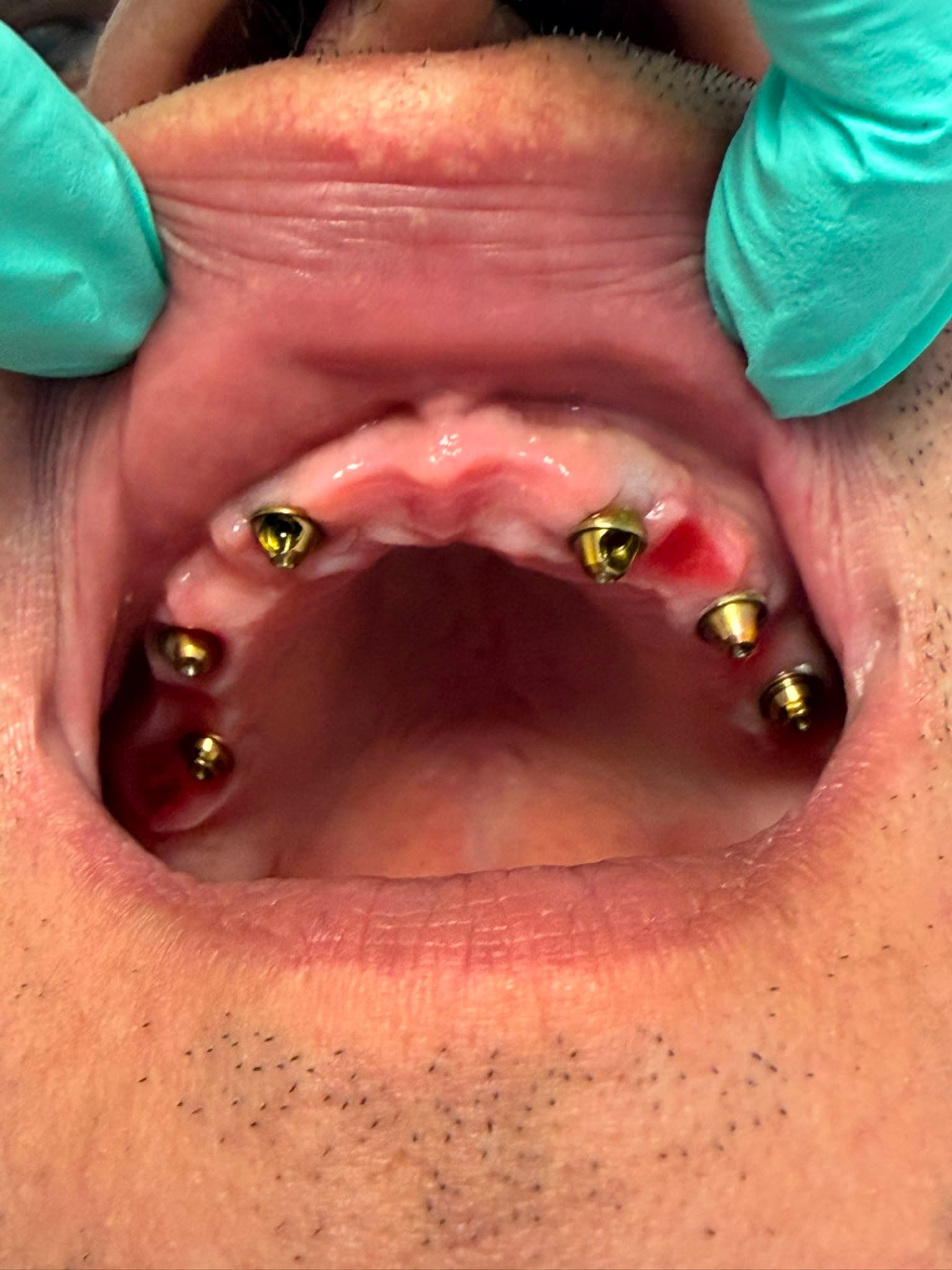Dinți din zirconiu și punte dentară - Rezultat 3
