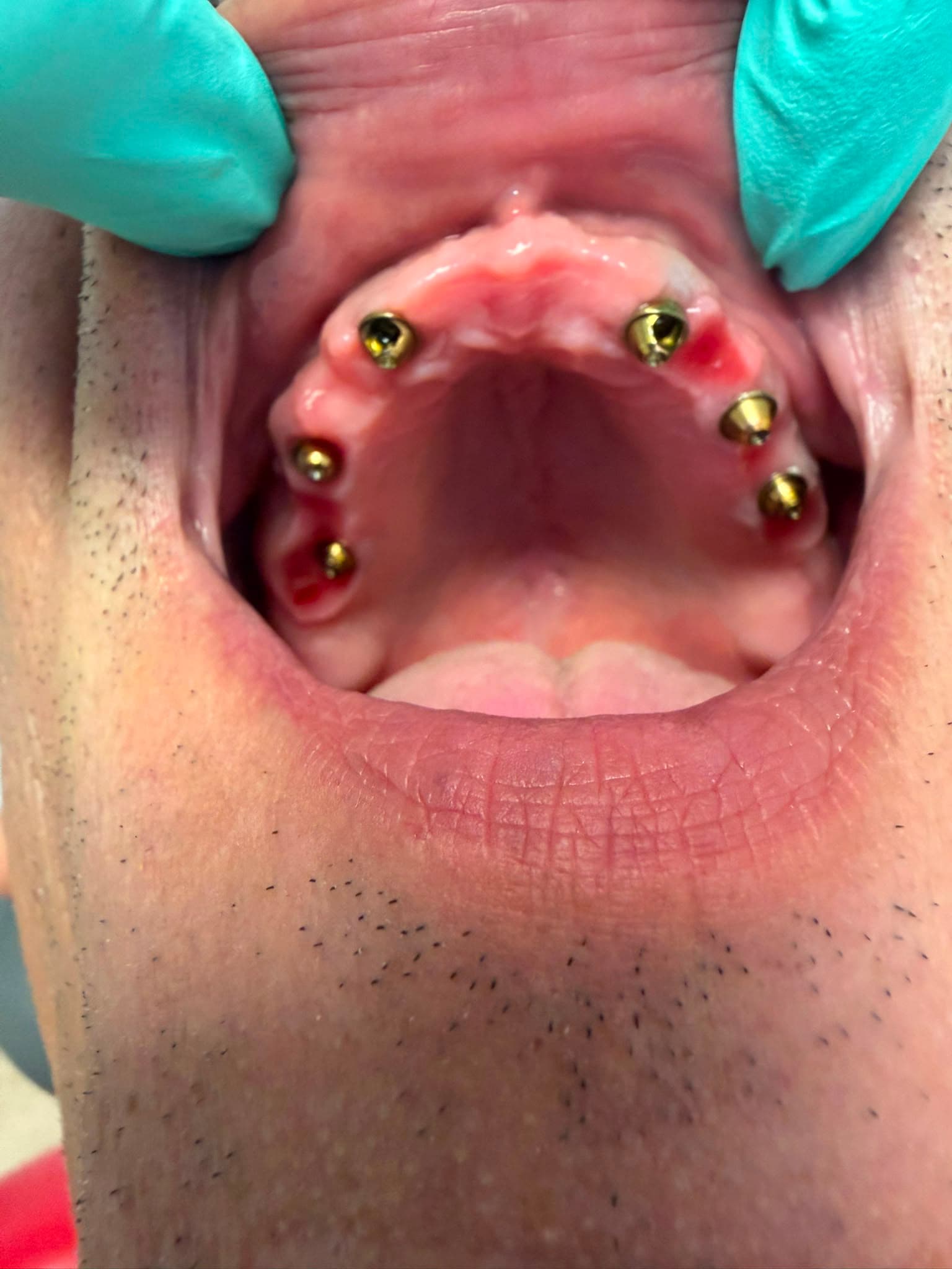 Dinți din zirconiu și punte dentară - Rezultat 4