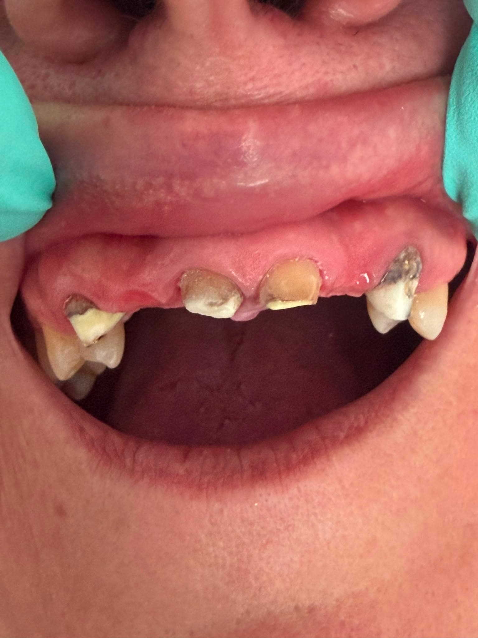 Dinți din zirconiu și punte dentară - Rezultat 5