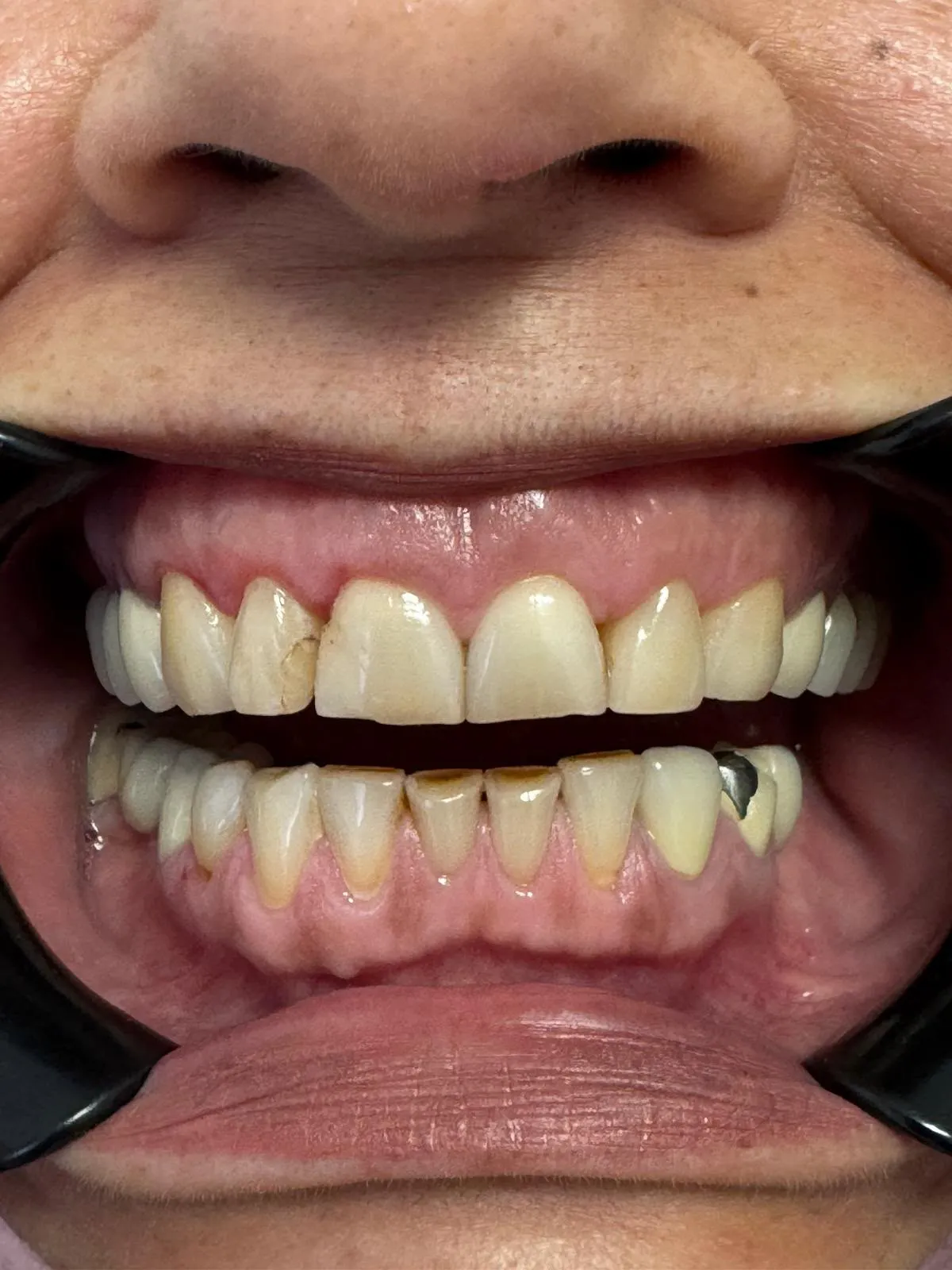 Rezultat fațete dentare - Caz 1